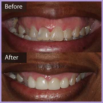 Before and after Gummy Smile Treatment