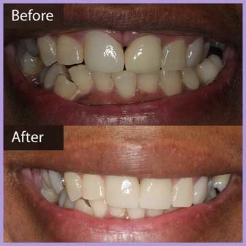 Before and After Crooked Teeth Treatment