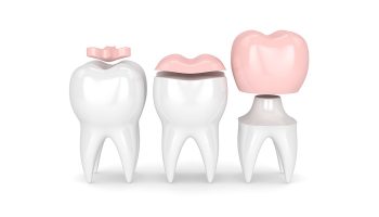 All the Unique Facts You Need to Know About Dental Crowns
